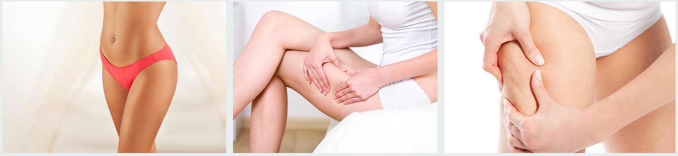 rimedi da usare subito contro la cellulite