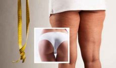 Tipi di cellulite: conoscerla per curarla