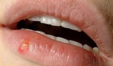 Rimedi naturali per l' herpes: il tea tree oil